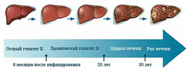 Стадии гепатита B