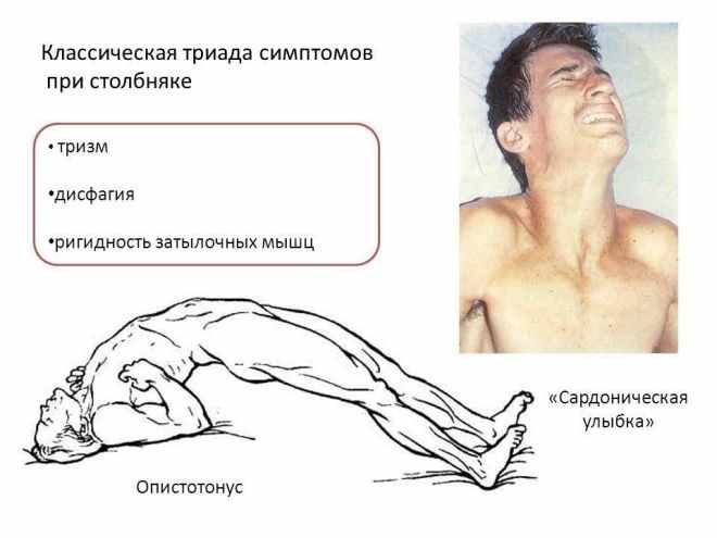 Симптомы столбняка