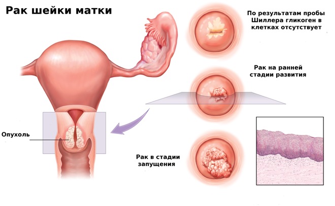 Что такое рак шейки матки