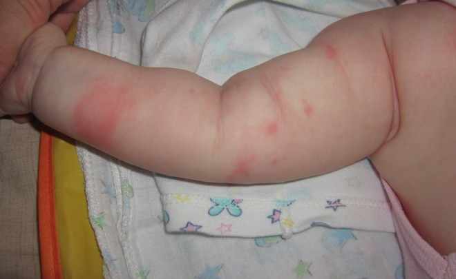 Аллергия на прививку АКДС