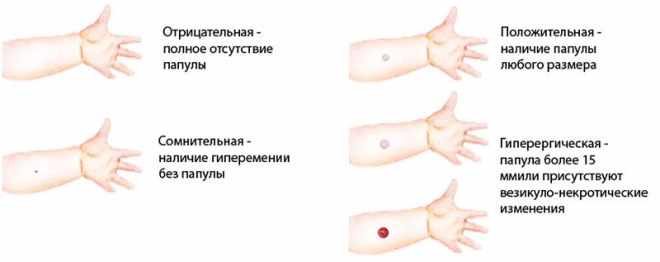 Виды реакции на Манту