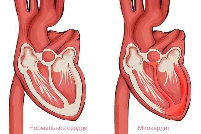 Миокардит