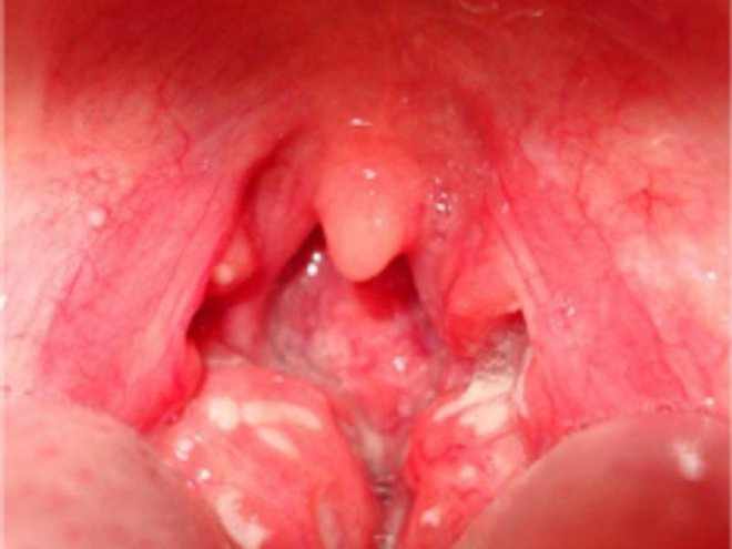 Отёк гортани