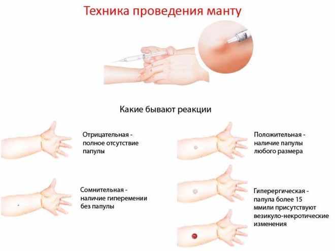 Нормы размеров папулы при Манту