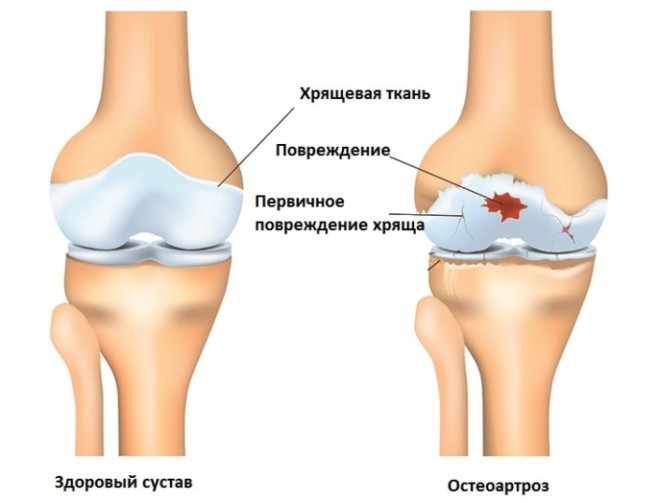 Остеоартроз