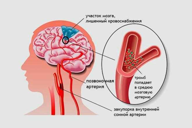Ишемия