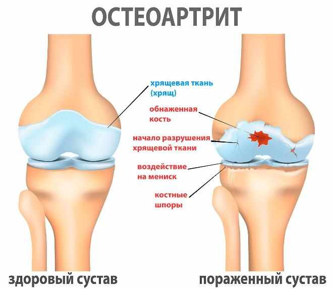 Остеоартрит суставов