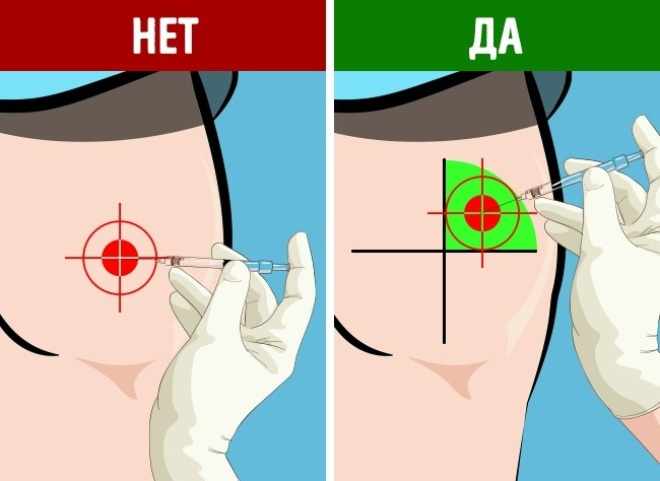 Внутримышечный укол