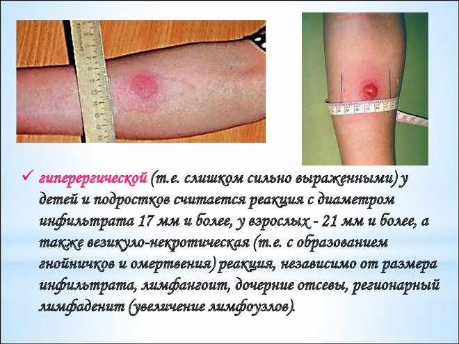 Что такое гиперергическая реакция