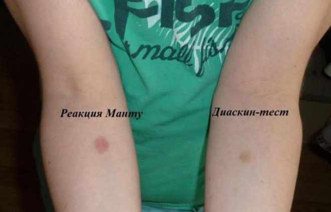 Результаты Манту и Диаскитеста
