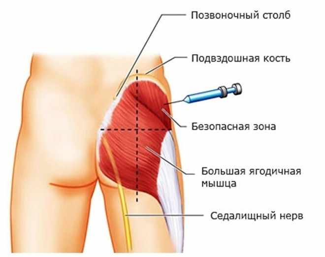 Как правильно колоть Комбилипен