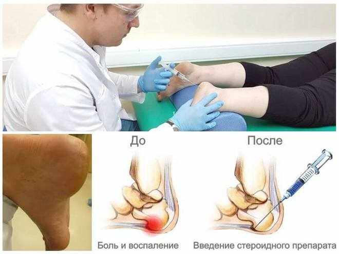 Как проводится укол в пятку