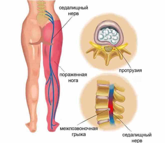 Что такое защемление седалищного нерва