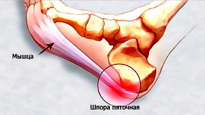 Пяточная шпора