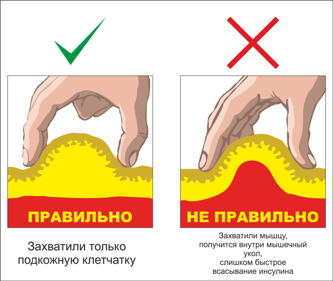 Как сформировать складку для укола