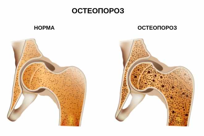 Остеопороз
