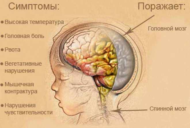 Симптомы менингита