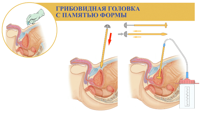 Применение катетера Пеццера