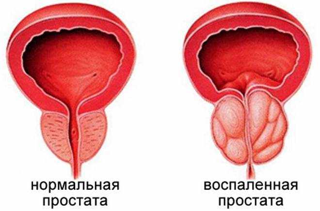 Простатит