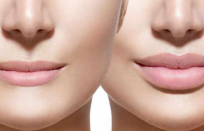 Увеличение губ гиалуроновой кислотой: до и после