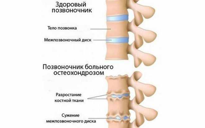 Остеохондроз