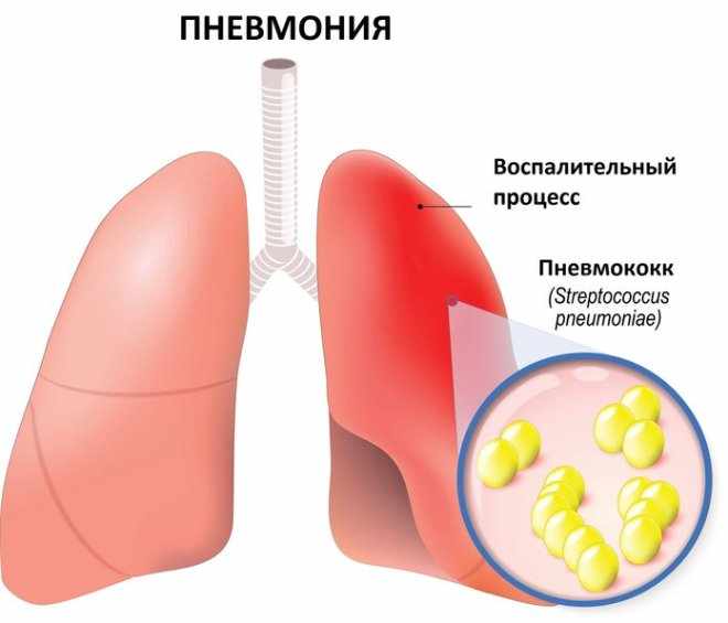 Пневмококковая пневмония