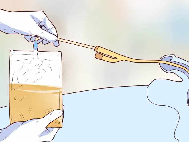 Что такое катетеризация мочевого пузыря