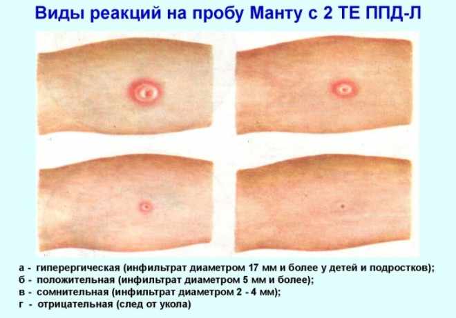 Виды реакций Манту