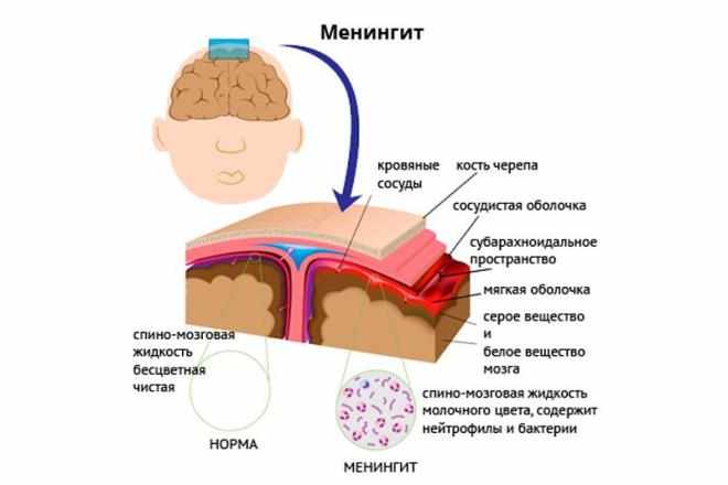 Что за болезнь менингит