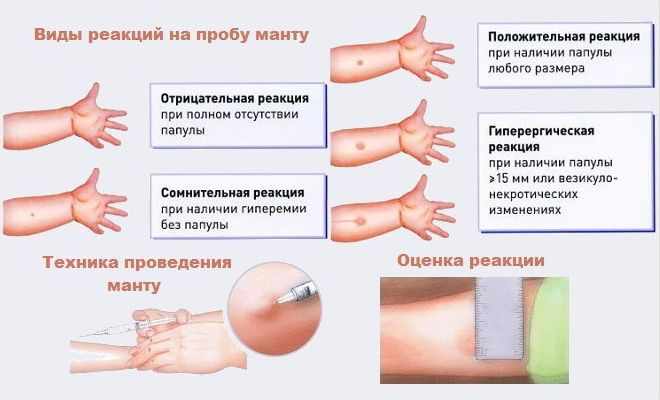 Расшифровка результатов Манту
