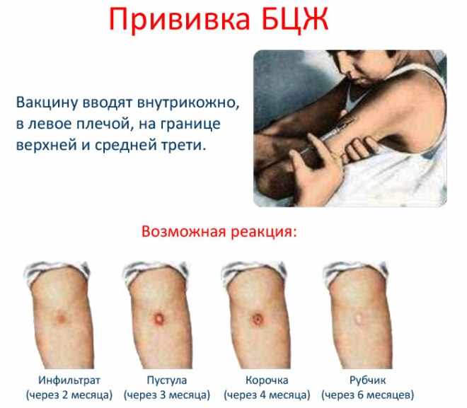 Реакции на прививку БЦЖ