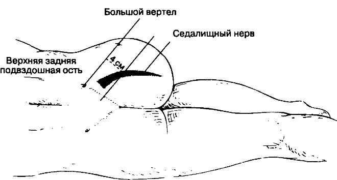 Техника блокады седалищного нерва