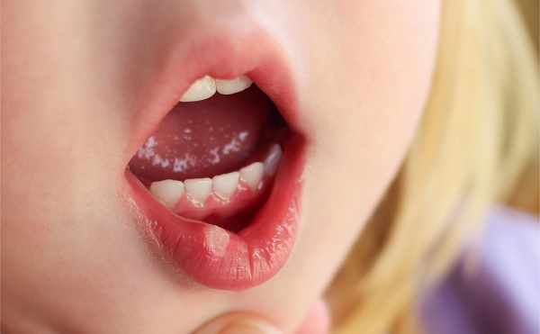 Стоматит у девочки на губе