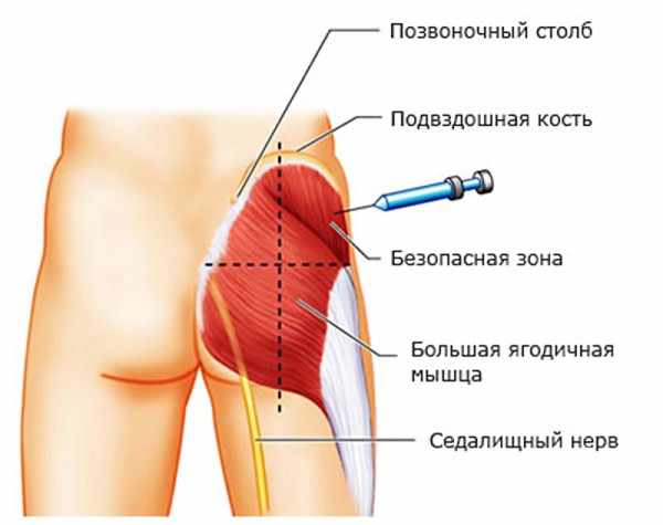Как делать укол