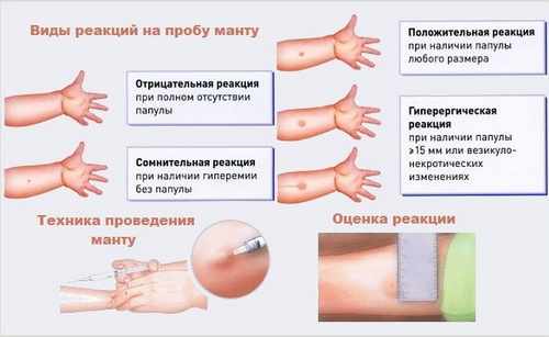 Реакция на пробу манту