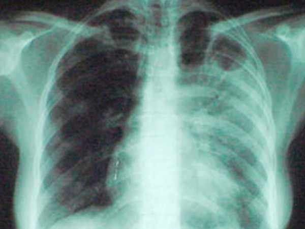 Туберкулёз на рентгене
