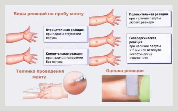 Прививка Манту оценка результатов