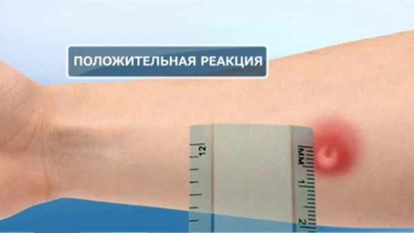 положительная реакция манту