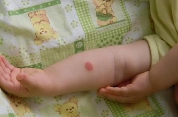 Отрицательная реакция манту