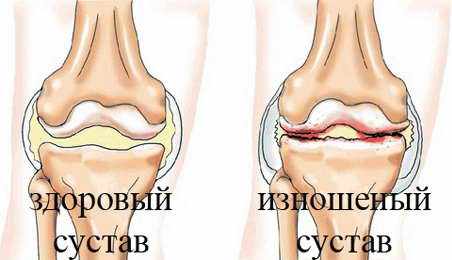 мелоксикам инструкция по применению уколы