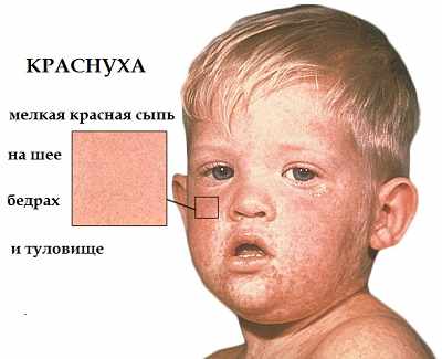 Краснуха