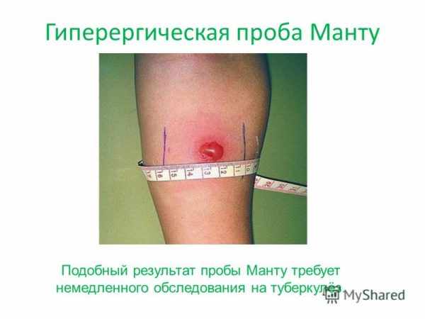Гиперергическая реакция на пробу Манту