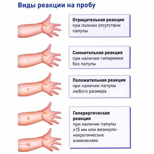 Виды реакций на пробу манту