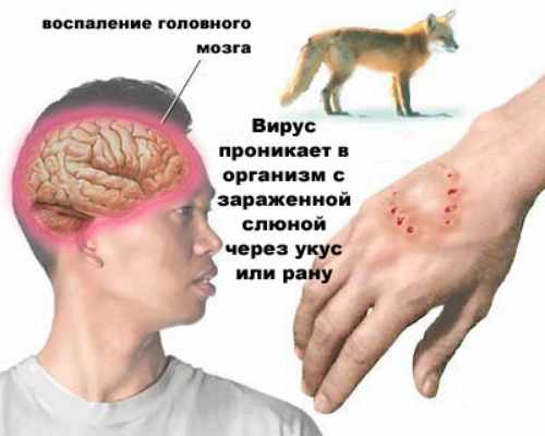 бешенство у человека