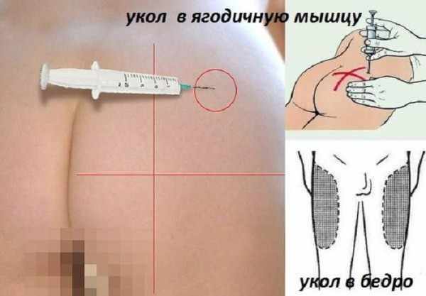 Укол в ягодицу