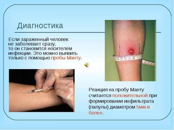 Таблица о диагностике манту