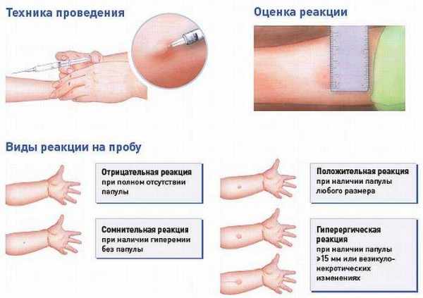 Оценка манту
