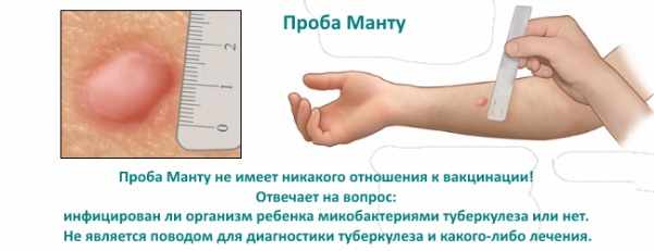Проба манту 