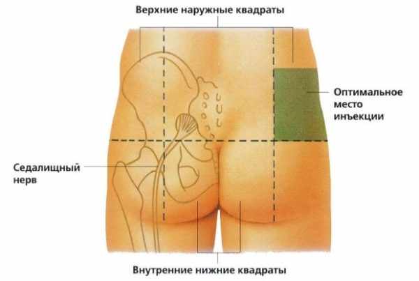 кеторол уколы инструкция по применению