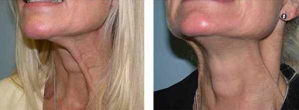 Инъекции Диспорта